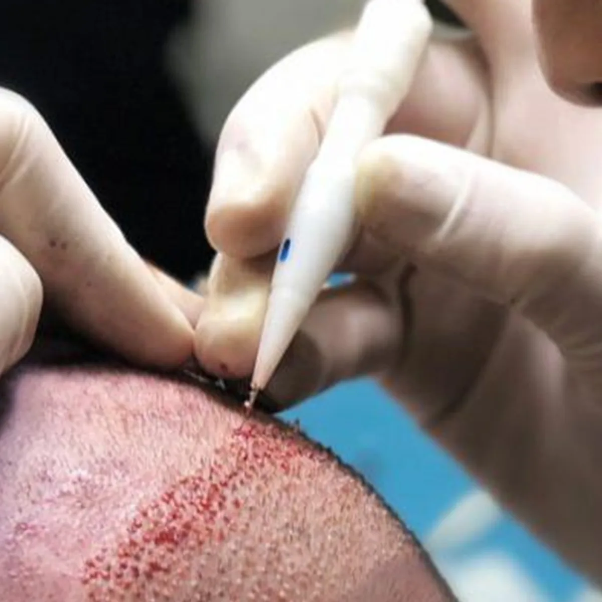 DHI Haartransplantation